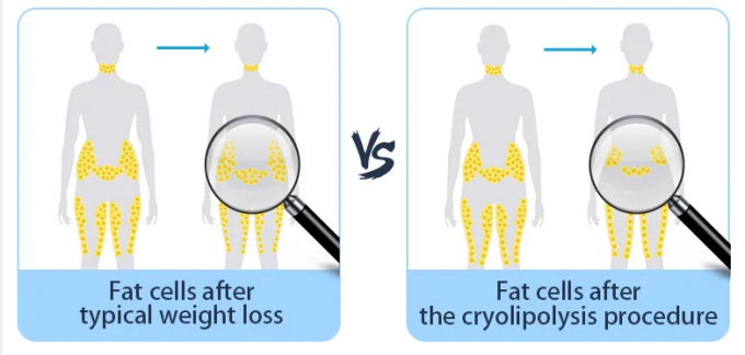 Fetter Frost Cryolipolysis, der Maschinen-Umfang und Cellulite-Reduzierung abnimmt