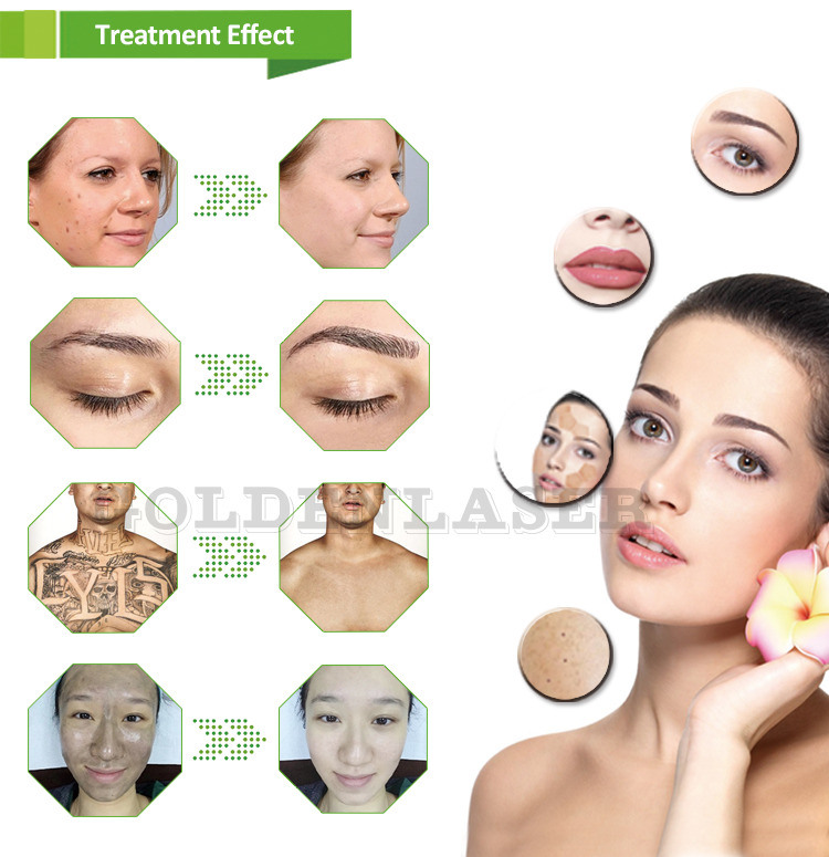 Experience Smooth and Hair-Free Skin with Diode Laser Hair Removal Machine